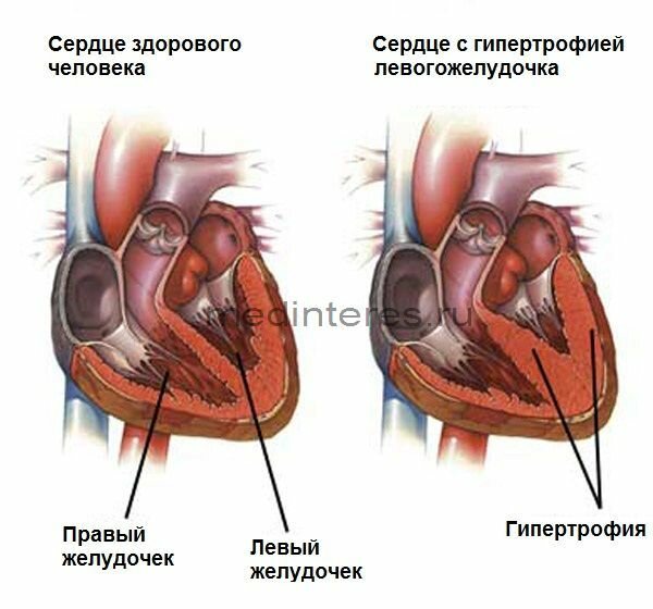 артериальная гипертензия